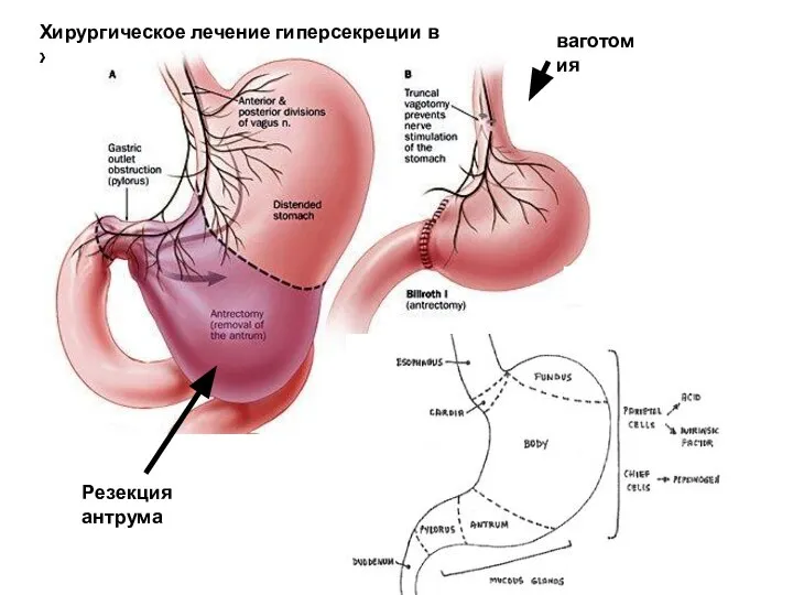 Хирургическое лечение гиперсекреции в желудке ваготомия Резекция антрума