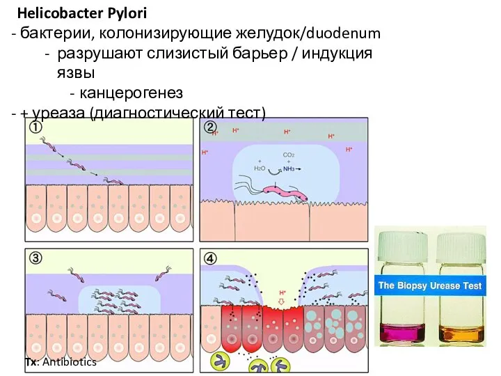 Helicobacter Pylori бактерии, колонизирующие желудок/duodenum разрушают слизистый барьер / индукция язвы канцерогенез