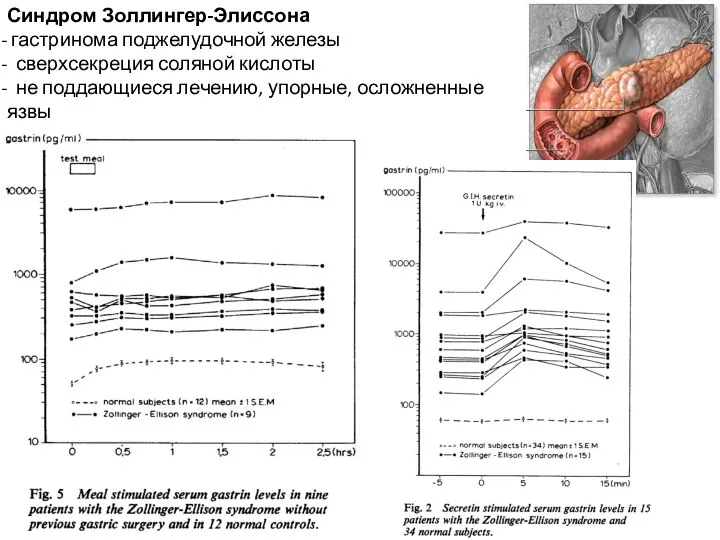 Синдром Золлингер-Элиссона гастринома поджелудочной железы сверхсекреция соляной кислоты не поддающиеся лечению, упорные, осложненные язвы