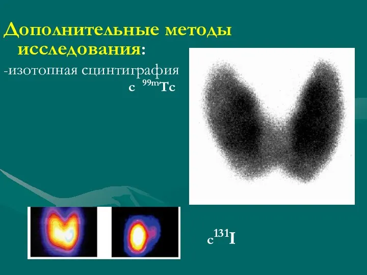 Дополнительные методы исследования: -изотопная сцинтиграфия с 99mТс c131I c