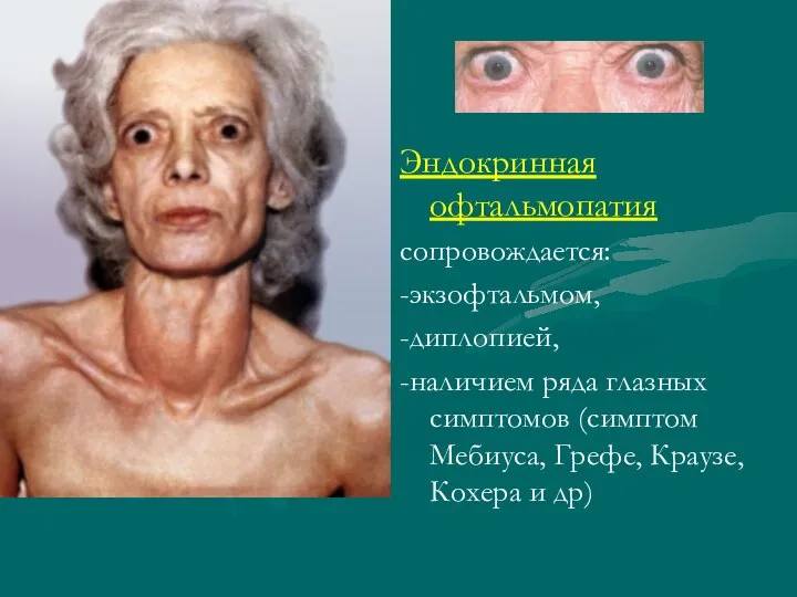 Эндокринная офтальмопатия сопровождается: -экзофтальмом, -диплопией, -наличием ряда глазных симптомов (симптом Мебиуса, Грефе, Краузе, Кохера и др)