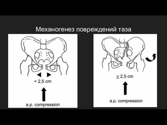 Механогенез повреждений таза