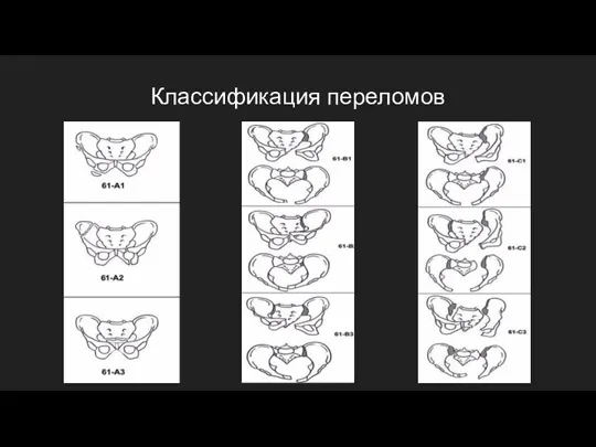 Классификация переломов