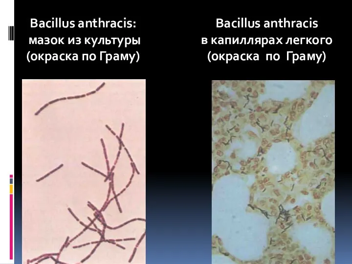 Bacillus anthracis: мазок из культуры (окраска по Граму) Bacillus anthracis в капиллярах легкого (окраска по Граму)