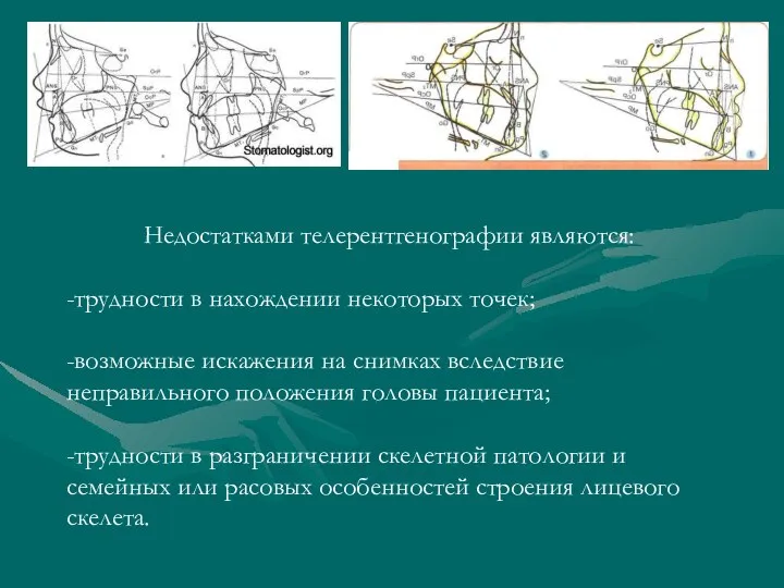 Недостатками телерентгенографии являются: -трудности в нахождении некоторых точек; -возможные искажения на снимках