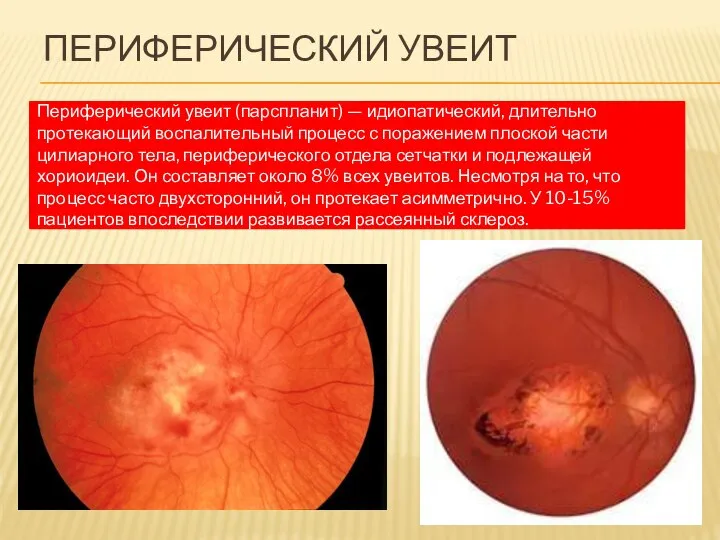 ПЕРИФЕРИЧЕСКИЙ УВЕИТ Периферический увеит (парспланит) — идиопатический, длительно протекающий воспалительный процесс с