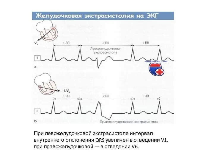 При левожелудочковой экстрасистоле интервал внутреннего от­клонения QRS увеличен в отведении V1, при