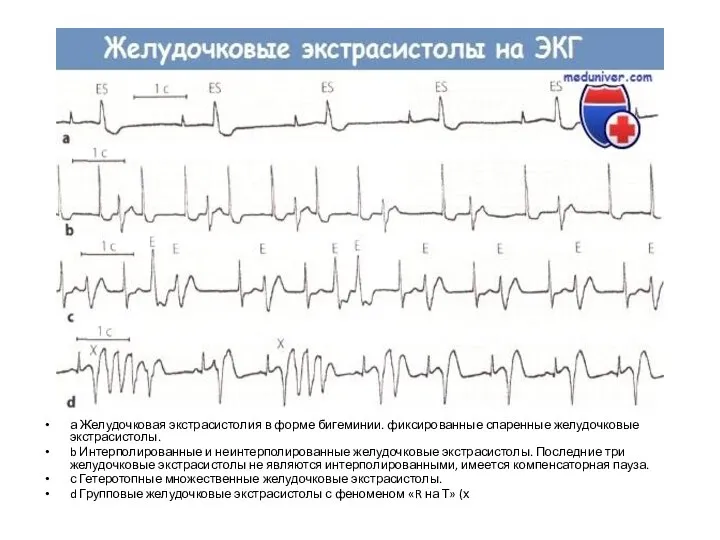 а Желудочковая экстрасистолия в форме бигеминии. фиксированные спаренные желудочковые экстрасистолы. b Интерполированные