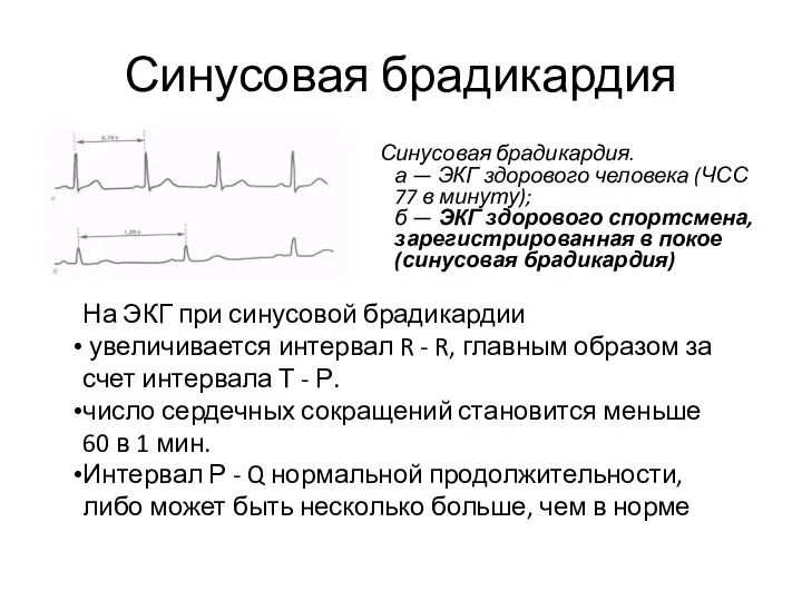 Синусовая брадикардия Синусовая брадикардия. а — ЭКГ здорового человека (ЧСС 77 в