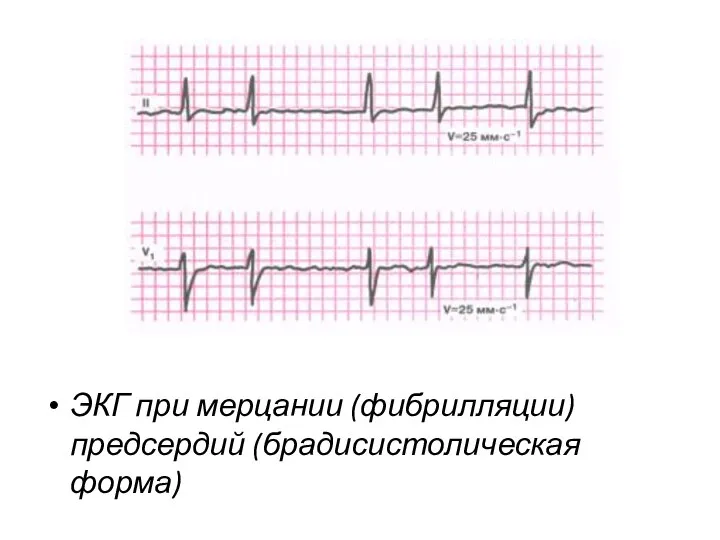 ЭКГ при мерцании (фибрилляции) предсердий (брадиси­столическая форма)