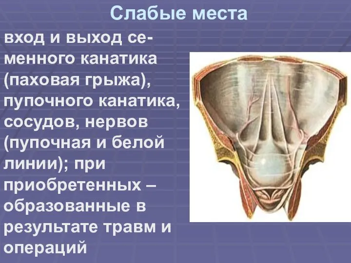 Слабые места вход и выход се-менного канатика (паховая грыжа), пупочного канатика, сосудов,