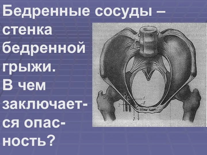 Бедренные сосуды – стенка бедренной грыжи. В чем заключает- ся опас- ность?