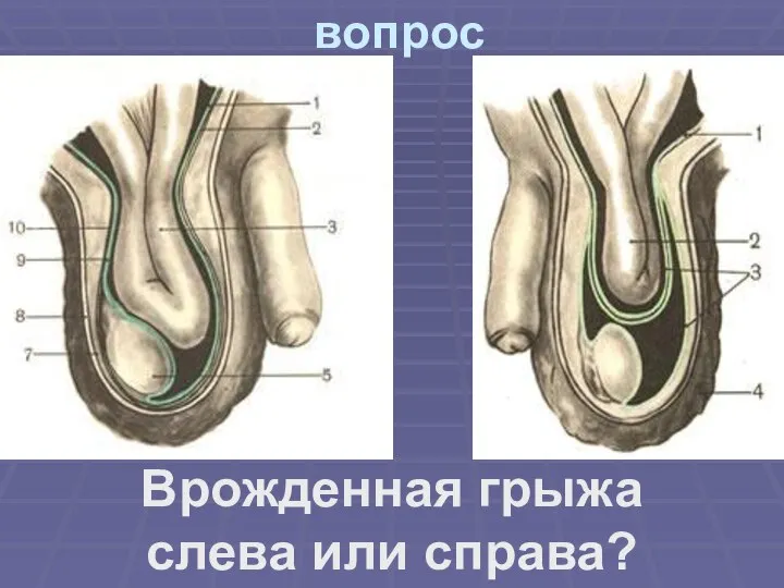 вопрос Врожденная грыжа слева или справа?