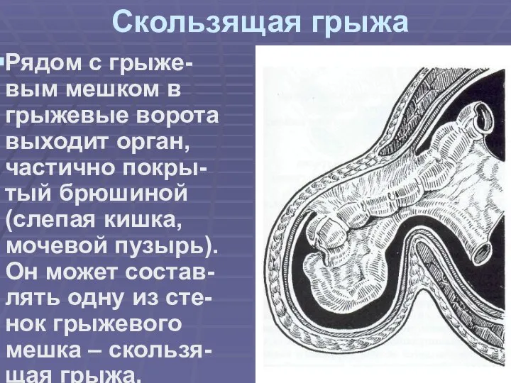 Скользящая грыжа Рядом с грыже-вым мешком в грыжевые ворота выходит орган, частично