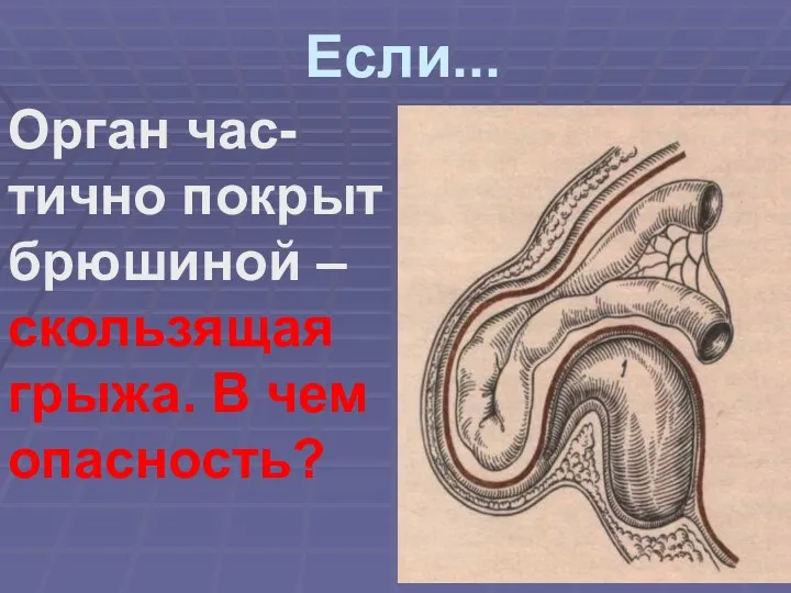 Если... Орган час- тично покрыт брюшиной – скользящая грыжа. В чем опасность?