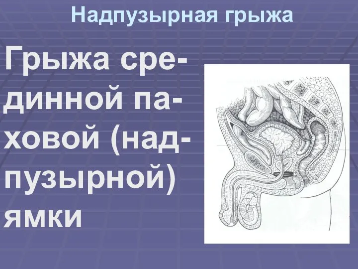 Надпузырная грыжа Грыжа сре- динной па- ховой (над-пузырной) ямки