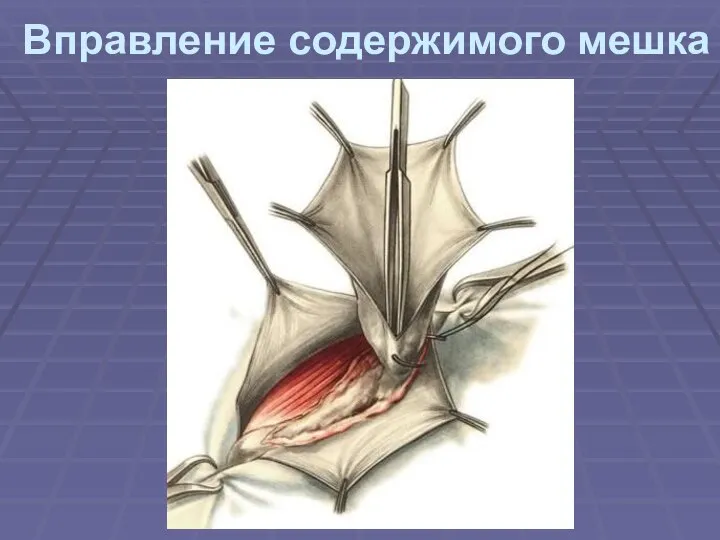 Вправление содержимого мешка