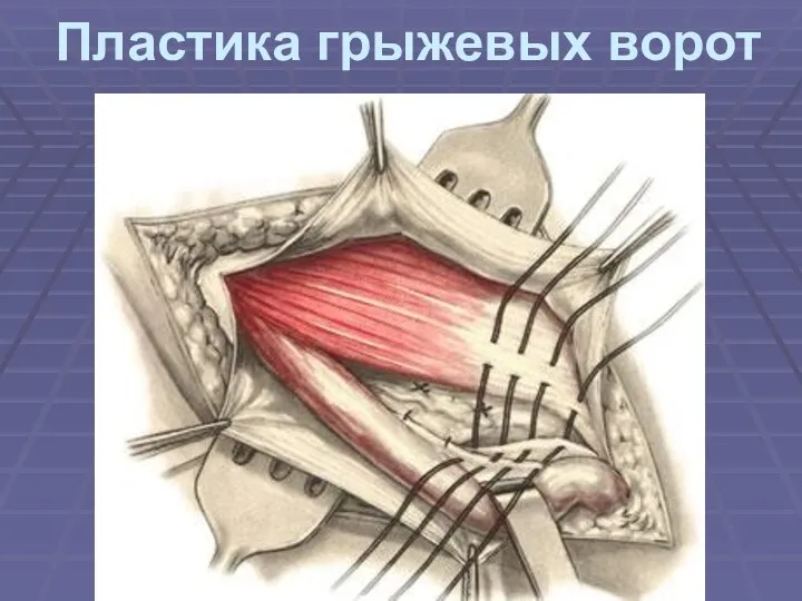 Пластика грыжевых ворот