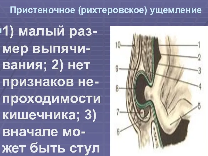 Пристеночное (рихтеровское) ущемление 1) малый раз-мер выпячи-вания; 2) нет признаков не-проходимости кишечника;