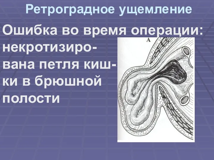 Ретроградное ущемление Ошибка во время операции: некротизиро- вана петля киш- ки в брюшной полости