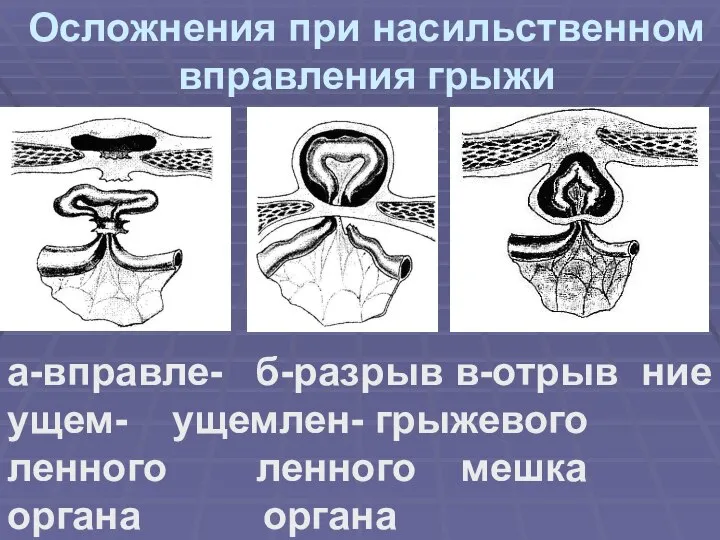 Осложнения при насильственном вправления грыжи а-вправле- б-разрыв в-отрыв ние ущем- ущемлен- грыжевого