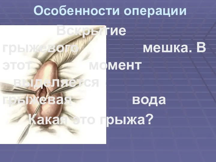 Особенности операции Вскрытие грыжевого мешка. В этот момент выделяется грыжевая вода Какая это грыжа?