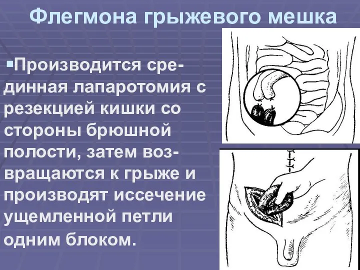 Флегмона грыжевого мешка Производится сре-динная лапаротомия с резекцией кишки со стороны брюшной