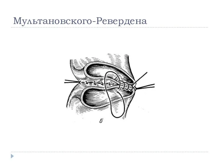 Мультановского-Ревердена