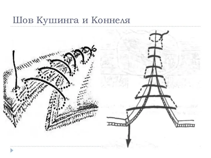 Шов Кушинга и Коннеля