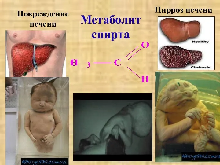 Повреждение печени Метаболит спирта Цирроз печени