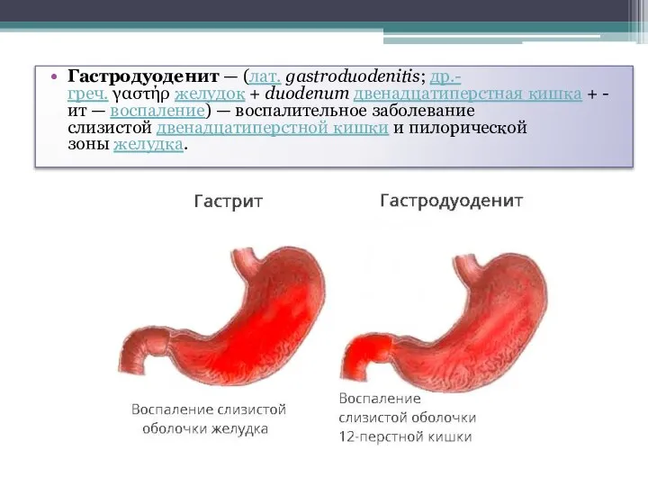 Гастродуоденит — (лат. gastroduodenitis; др.-греч. γαστήρ желудок + duodenum двенадцатиперстная кишка +