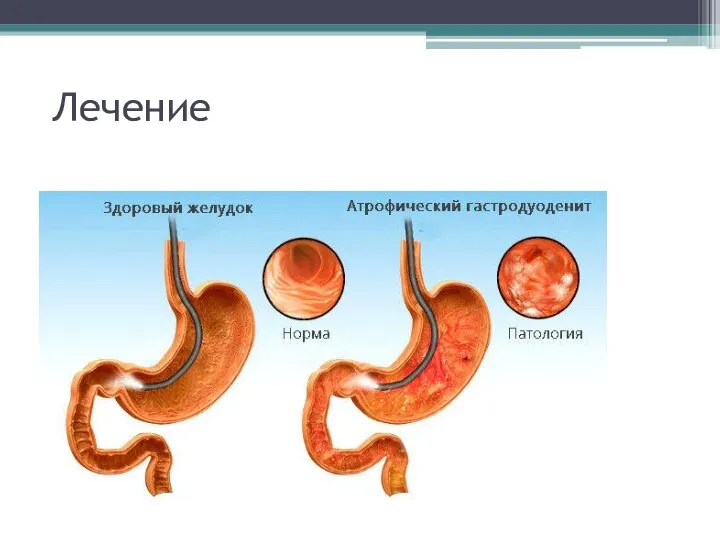 Лечение