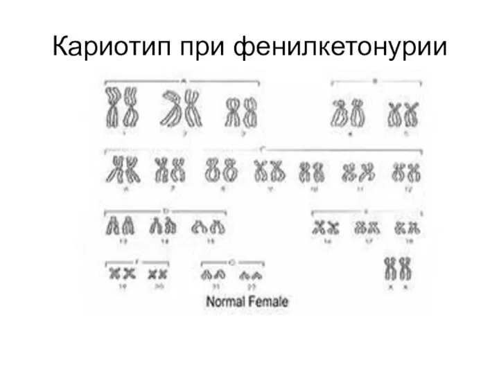 Кариотип при фенилкетонурии