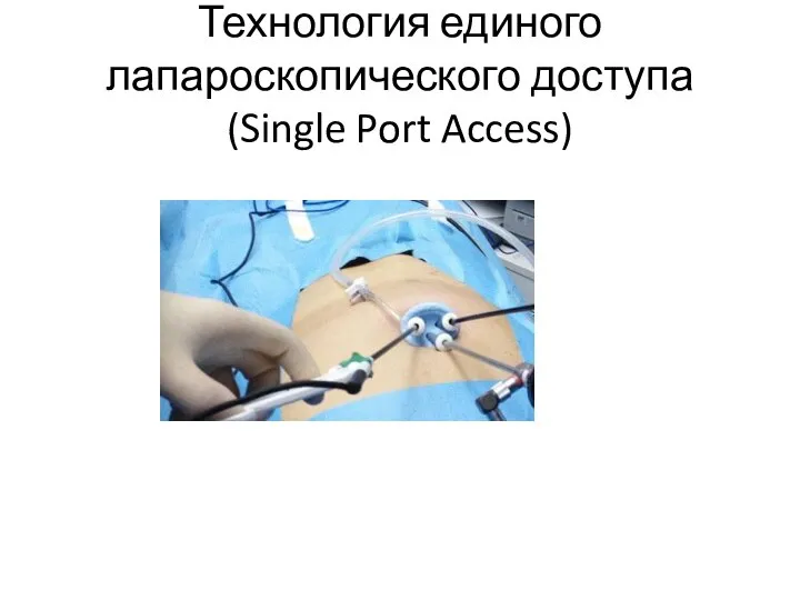 Технология единого лапароскопического доступа (Single Port Access)