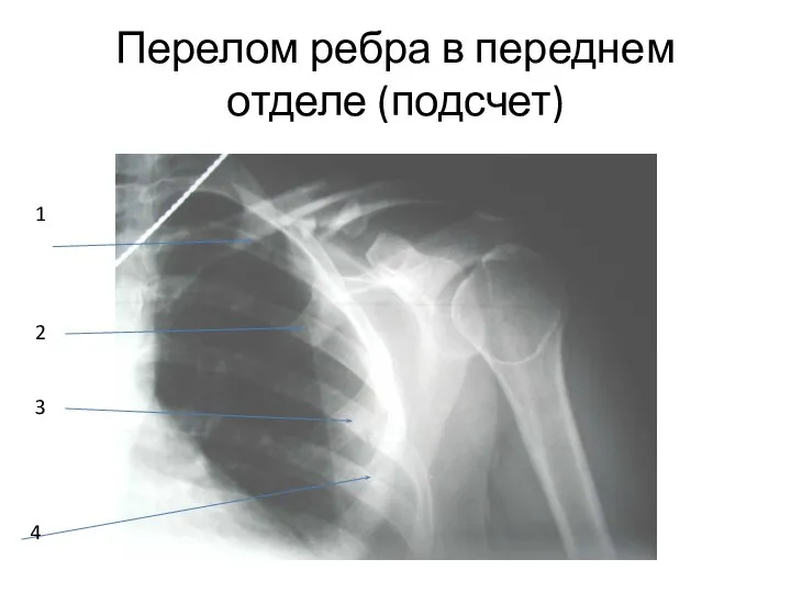 Перелом ребра в переднем отделе (подсчет) 1 2 3 4