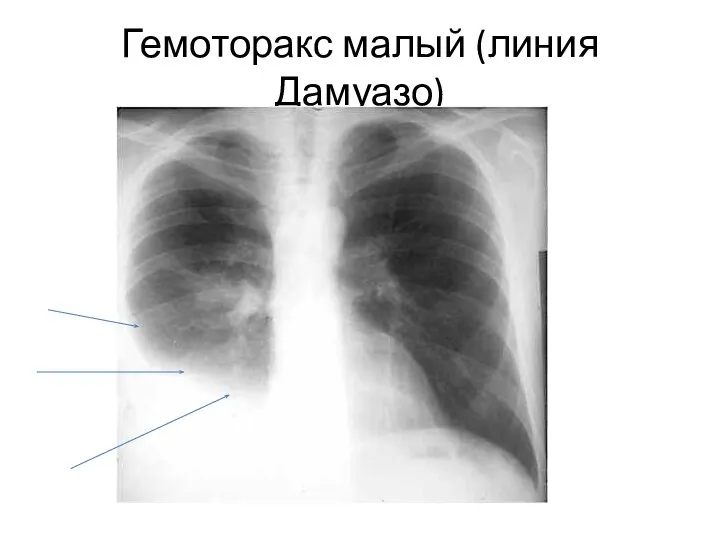 Гемоторакс малый (линия Дамуазо)