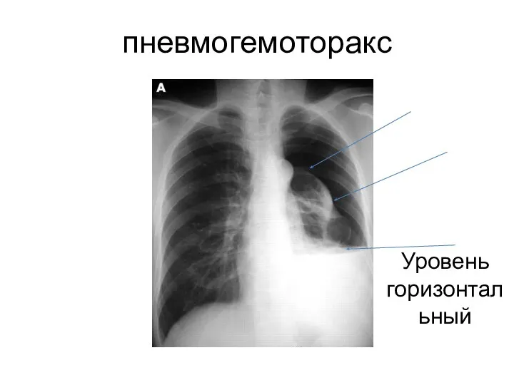 пневмогемоторакс Уровень горизонтальный