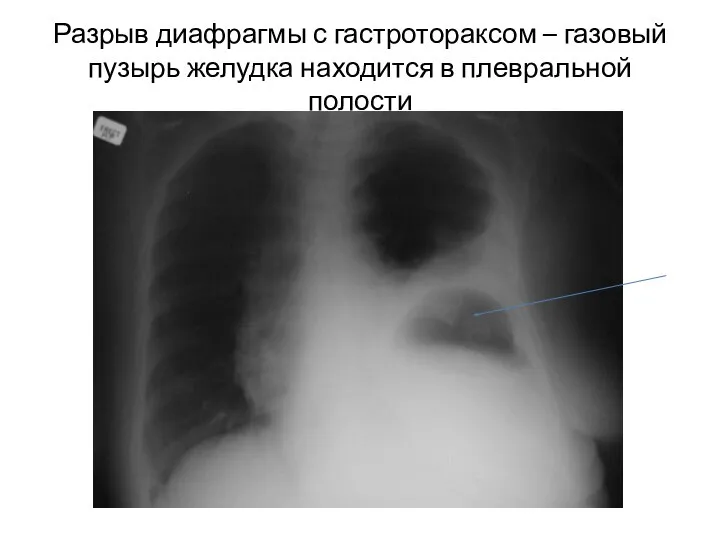 Разрыв диафрагмы с гастротораксом – газовый пузырь желудка находится в плевральной полости