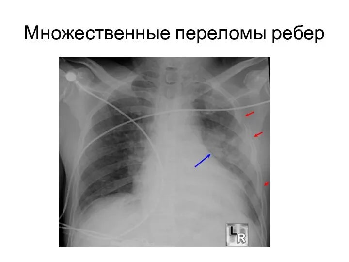 Множественные переломы ребер