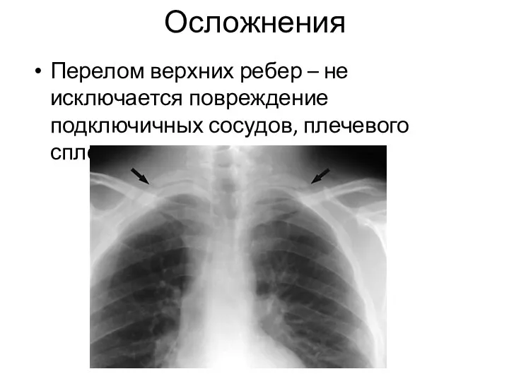 Осложнения Перелом верхних ребер – не исключается повреждение подключичных сосудов, плечевого сплетения