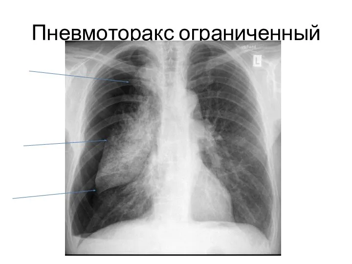 Пневмоторакс ограниченный