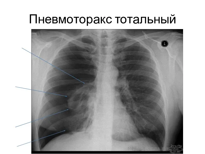 Пневмоторакс тотальный