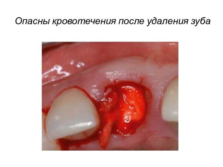 Опасны кровотечения после удаления зуба