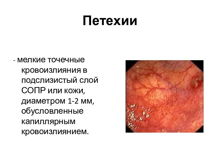 Петехии - мелкие точечные кровоизлияния в подслизистый слой СОПР или кожи, диаметром