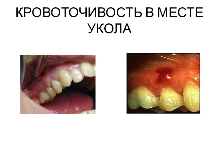 КРОВОТОЧИВОСТЬ В МЕСТЕ УКОЛА