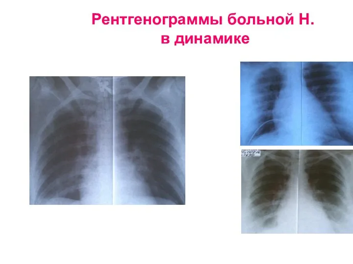 Рентгенограммы больной Н. в динамике