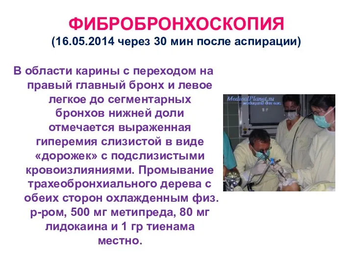 ФИБРОБРОНХОСКОПИЯ (16.05.2014 через 30 мин после аспирации) В области карины с переходом