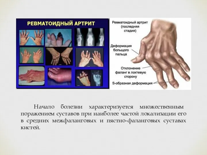 Начало болезни характеризуется множественным поражением суставов при наиболее частой локализации его в