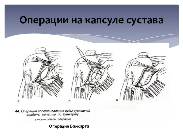 Операции на капсуле сустава Операция Банкарта