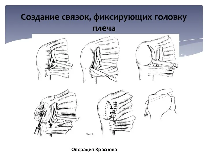 Создание связок, фиксирующих головку плеча Операция Краснова